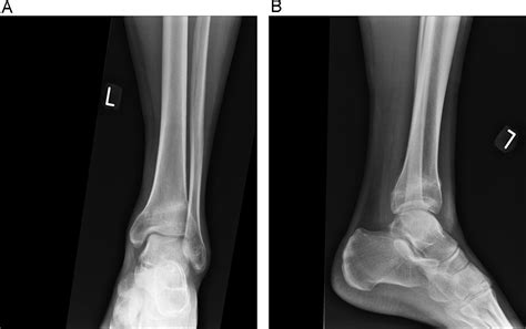 Bilateral Distal Tibial Stress Fractures In A Military Recruit Bmj