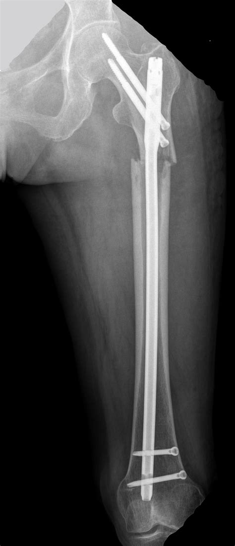 X Ray Showed Imn In A 69 Year Old Female With Bone Metastasis Of Lung