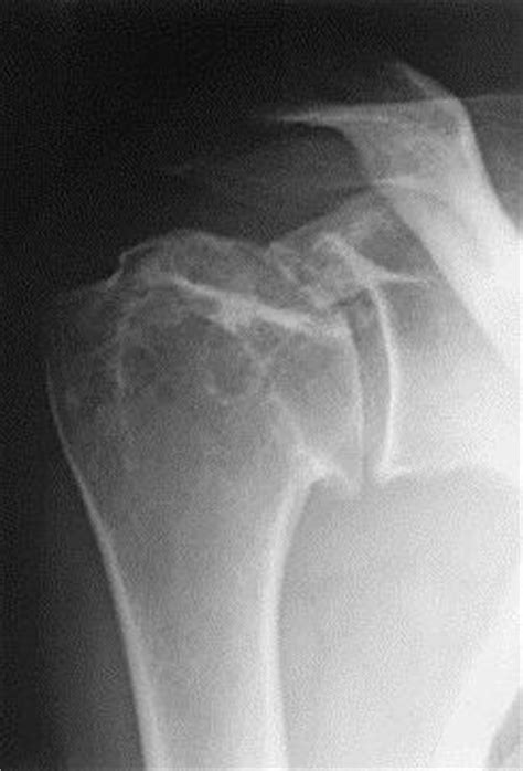 Avascular Necrosis Of The Shoulder Shoulder Elbow Orthobullets