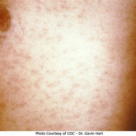 How To Recognize Pityriasis Rosea