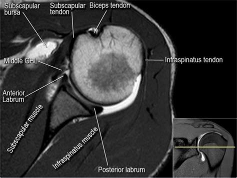 Mri Musculo Skeletal Section Mri Anatomy Of The Shoulder Axial View