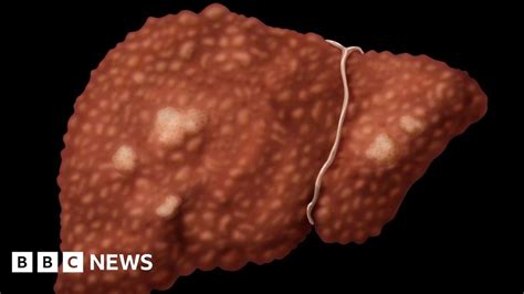Viral Hepatitis Kills As Many As Aids Or Tb Bbc News