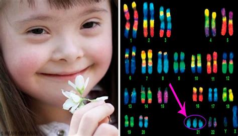 Síndrome de down o síndrome de down es una condición congénita causada por la presencia de una copia adicional del cromosoma 21 en las células de una persona. El síndrome de Down: ¿qué es? — Mejor con Salud