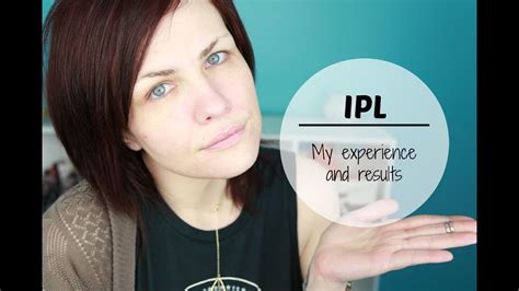 Ipl For Acne Scars My Experience Before And After Youtube