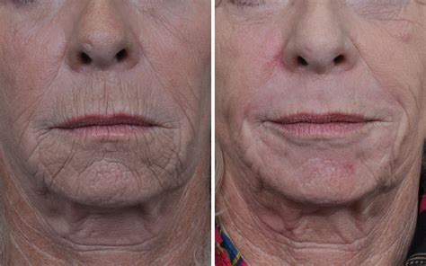 Laser Skin Resurfacing Before And After Annapolis Plastic