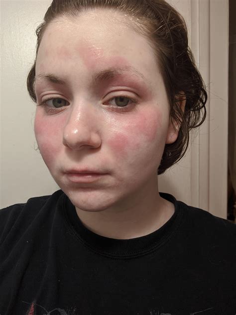 Itchy Flakey Red Rash Spreading Over Face Since Around June I Have