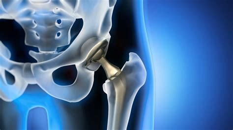 The Partial Hip Replacement Recovery Timeline Orange County