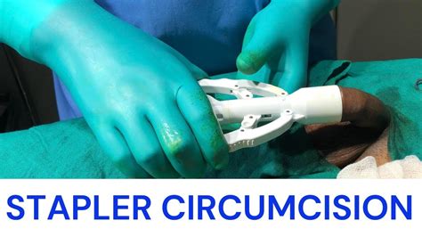 Phimosis Best Doctor For Circumcision Zsr Circumcision YouTube