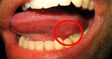 Home Remedies For Canker Sore On Tongue