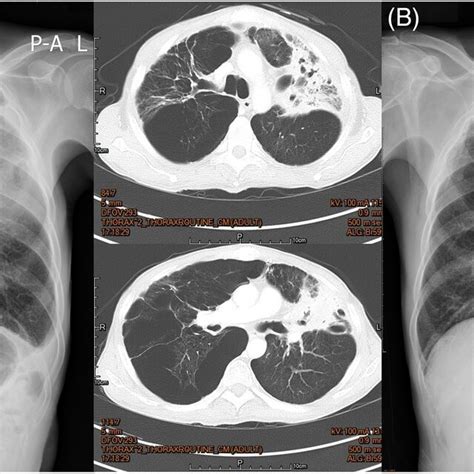 A Chest X‐ray Cxr And Computed Tomography Ct Imagines Showing An