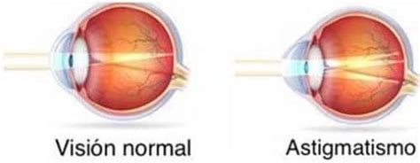 Astigmatismo Qué es y cómo se trata Área Oftalmológica Avanzada