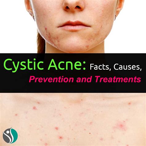 Cystic Acne Facts Causes Prevention And Treatments Consumer