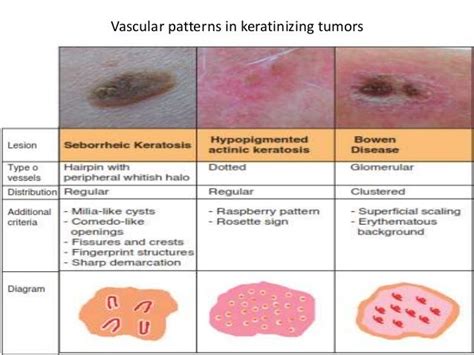 Difference Between Actinic Keratosis And Seborrheic Keratosis Compare