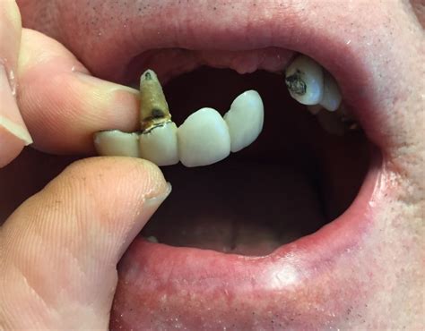 Partial Dentures Beforeafter Dr Gentry