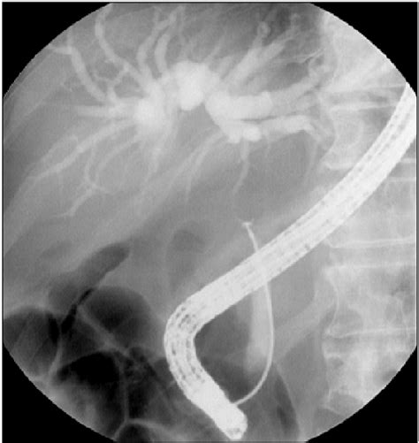 Endoscopic Retrograde Cholangiogram Reveals Malignant Stricture Of The