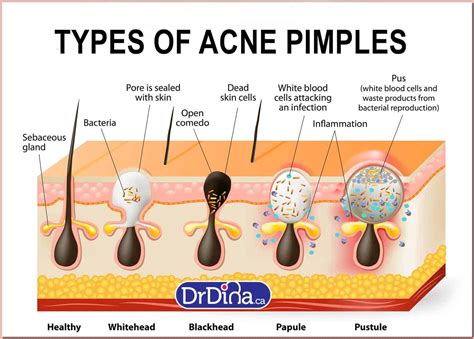 Baby acnes are bumps that normally affect the faces and sometimes may appear on the backs of babies. Dr Dina Kulik Baby Acne .. Different Types Of Acne And How To Prevent It