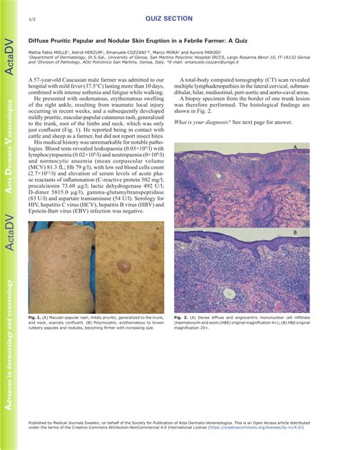 Pdf Diffuse Pruritic Papular And Nodular Skin Eruption In A Febrile
