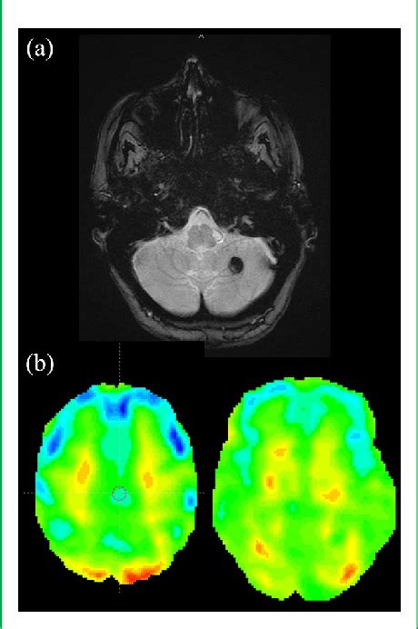 A Brain Mri With Axial T2 Sequence Shows A Hyposignal Lesion In The