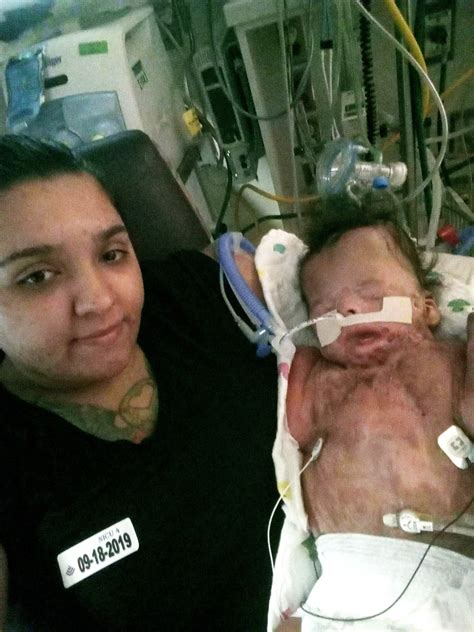 Mom Of Baby Born Without Skin Can Finally Kiss Her 10 Month Old Son