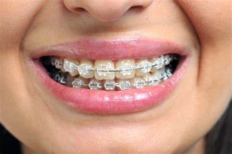 Orthodontists In Andover And Lawrence Ma Metal And Clear Braces