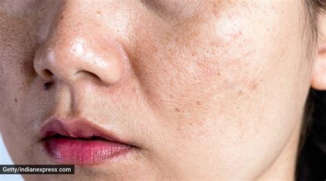 Clogged Pores Troubling You Count On These Skincare Tips Life Style