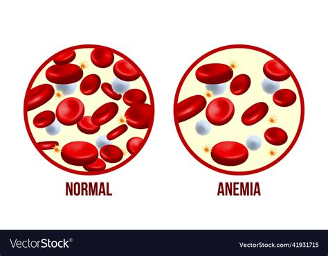 Iron Deficiency Anemiathe Difference Of Anemia Vector Image