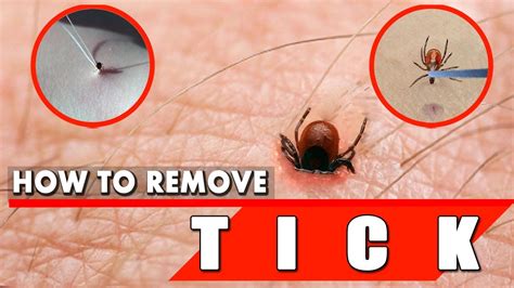 How To Remove A Tick Safely And Quickly Tick Removal Youtube