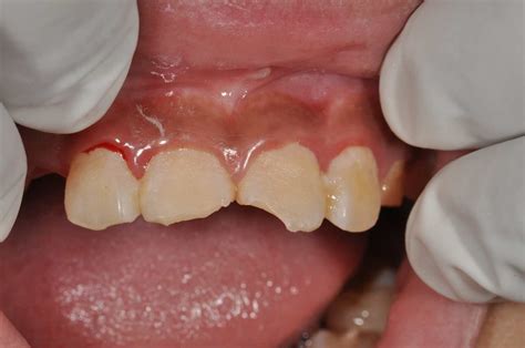 Cases Of Restoration With Composite Resin Prestige Dental My