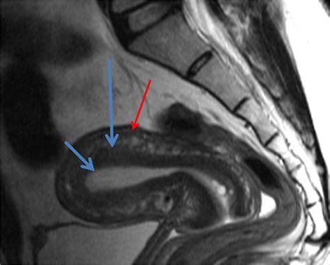 Zonal Anatomy Of Uterine Corpus On T2 Wtd Sagittal Image Download