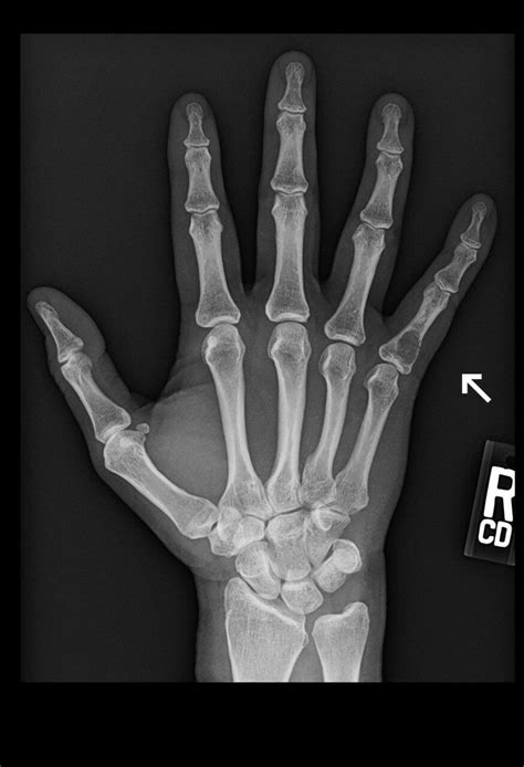 Orthodx Injury To Pinky Finger Clinical Advisor