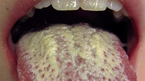 Hiv Bumps On Tongue