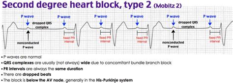 Second Degree Heart Block Mobitz Type Ii • P Waves Grepmed