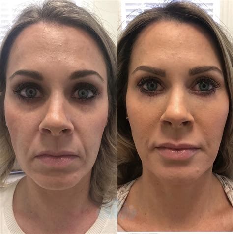 Botox Cosmetic Before And After Pictures Case 47 Charlotte Nc