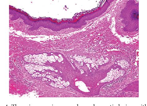 Figure 4 From Unusual Dermoid Cyst In Oral Cavity Semantic Scholar