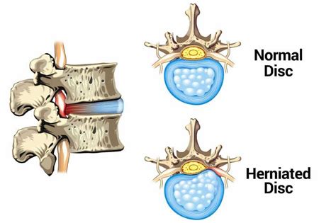 herniated disc surgery