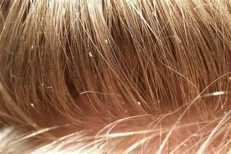 Incredible Lice In Blonde Hair Images Ideas Best Mode