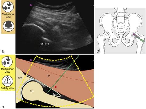 Intraarticular Hip Injection—anterior Approach Ultrasound Guidance Musculoskeletal Key