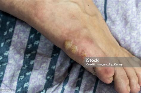 Multiple Blisters On Foot Stock Photo Download Image Now Adult