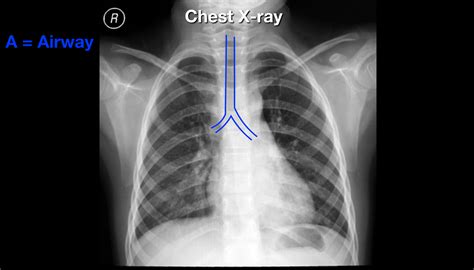 Read And Interpret Chest X Rays The Abcde Mnemonic Step By Step Practice Ezmed