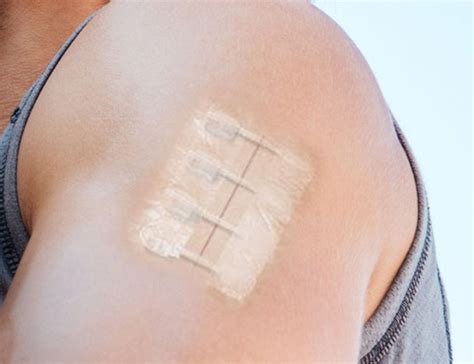 Zipstitch Is A Wound Closure Device That Works In Seconds