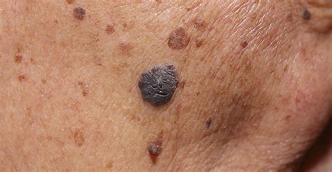 Mohs Skin Cancer Surgery Dermatology Consultants Of South Florida