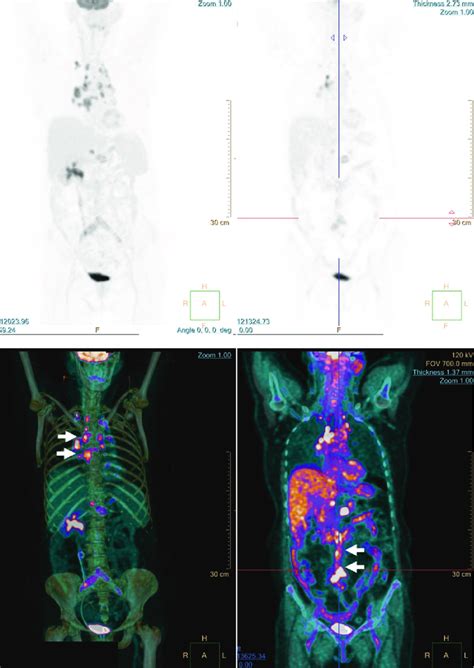 12 Whole Body Petct Images During The Index Admission Showing Multiple