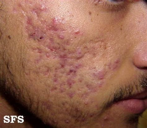 Skin Staph Infections With Pictures Hubpages