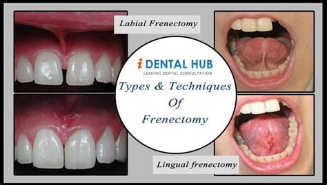 Frenectomy Is A Surgical Procedure In Which Frenum Is Removed