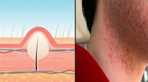 8 Home Remedies To Get Rid Of Ingrown Hairs And Razor Bumps My