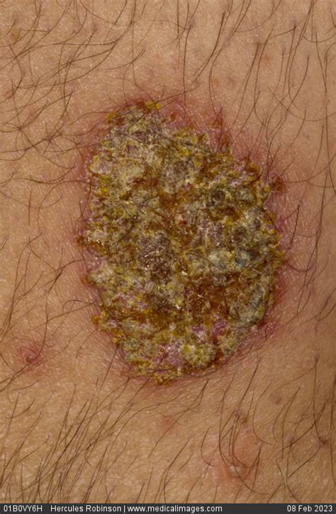Stock Image Discoid Eczema Nummular Eczema On A 56 Year Old Male