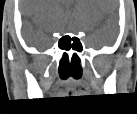 Normal Ct Paranasal Sinuses Image
