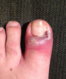 Infections on your toes may be common if you have diabetes or similar conditions that cause poor circulation or a weakened immune system. After lancing my infected big toe. | Shade Rupe | Flickr