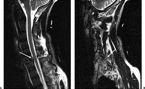 Management Of Cervical Facet Dislocations Role Of Magnetic Resonance