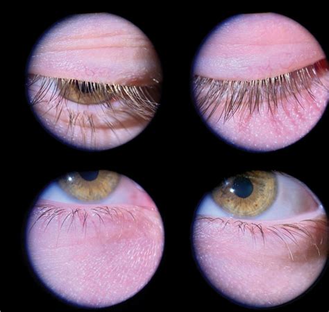 Blepharitis And Wearing Eye Makeup